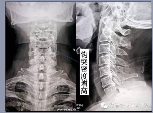 显示钩椎关节,关节突关节和神经根和椎动脉的关系 x-ray:颈椎右前斜位