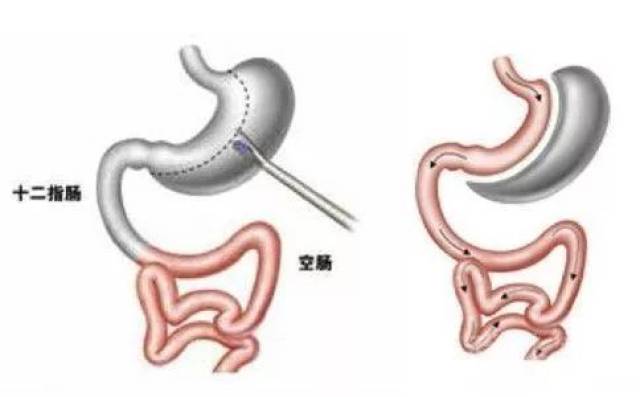 减重手术的前世今生