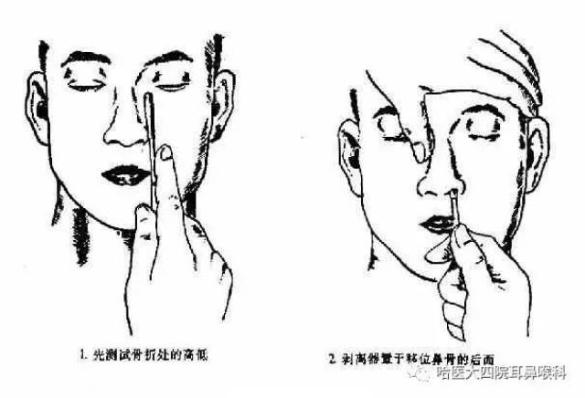 鼻骨骨折不容小觑