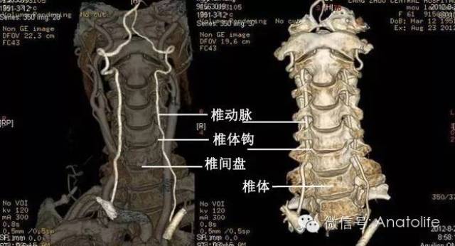 一,神经根型颈椎病 与神经根型颈椎病发病有关的解剖结构 构成椎间