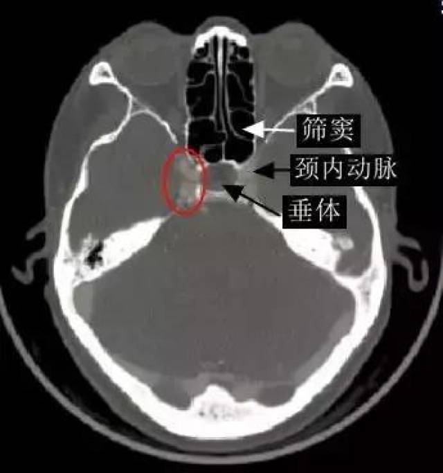 海绵窦区核磁共振影像解剖