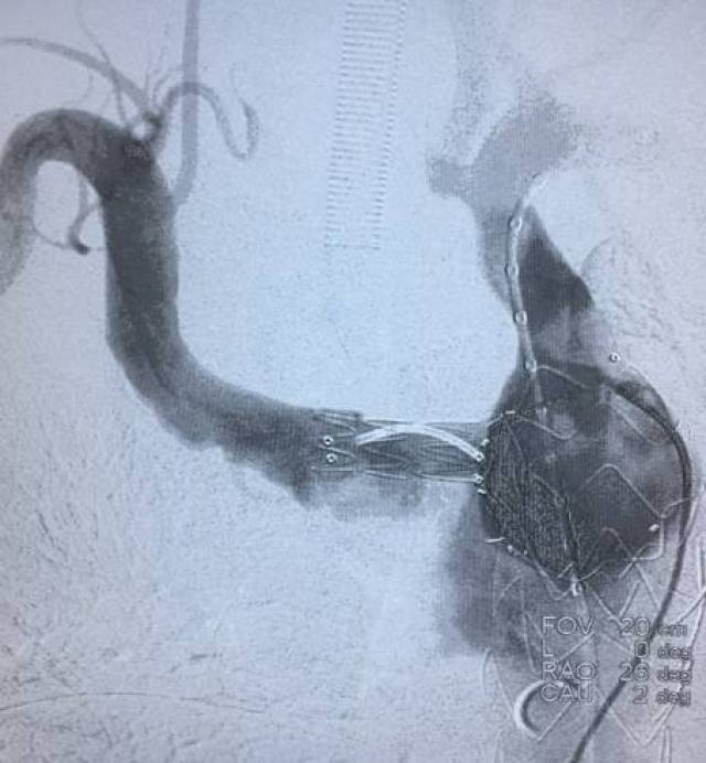 【病例分享】castor分支型主动脉覆膜支架系统治疗右锁骨下迷走主动脉