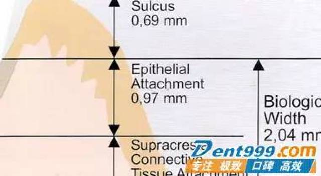 97mm宽度)及游离龈(上图中所指