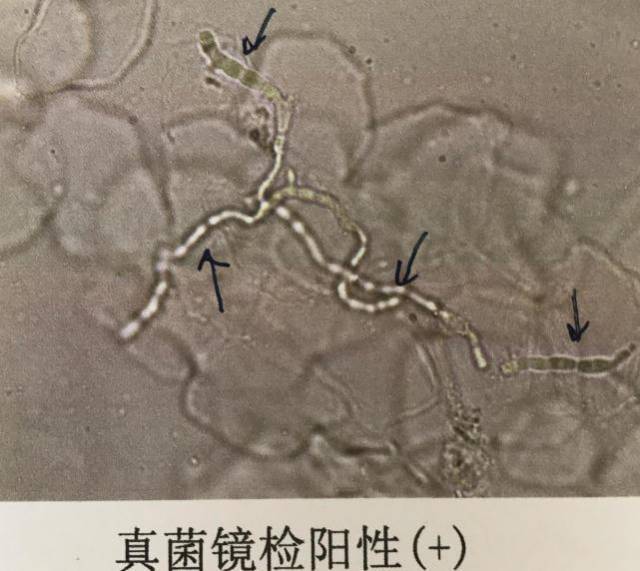 大腿根皮肤又红又痒,确诊是真菌感染的股癣,用药后却严重了