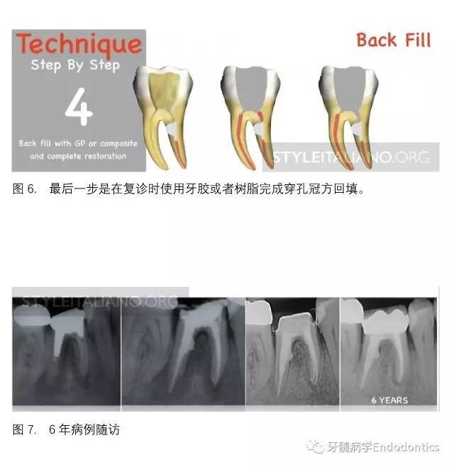 牙医学堂修补根管穿孔的mta三明治技术