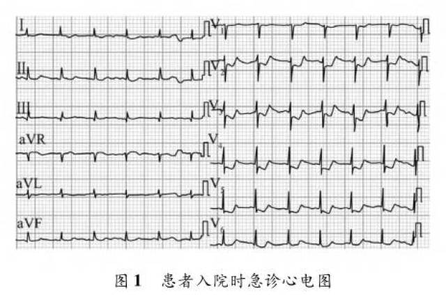 前降支心肌桥疑致急性心肌梗死一例
