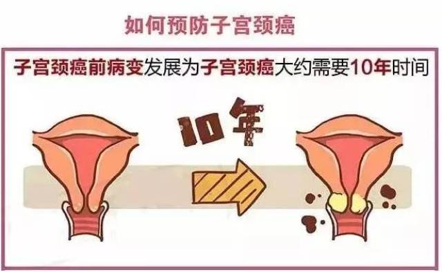 揪出女性健康"第一杀手"--宫颈癌,或许他可以帮到您