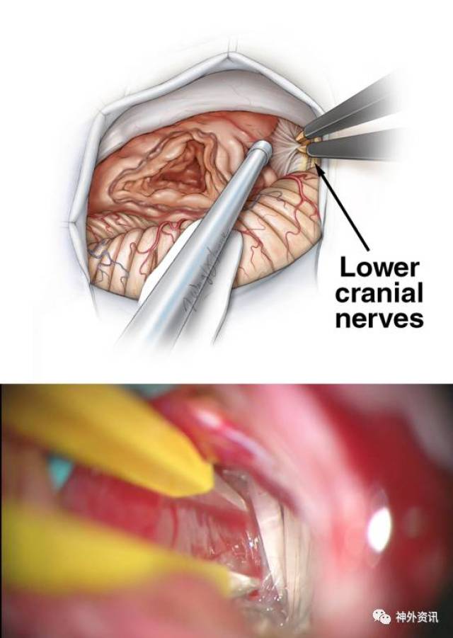 乙状窦后入路切除听神经瘤手术策略与技巧丨the neurosurgical atlas