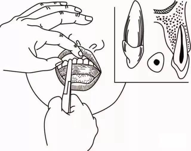 拔牙钳的正确使用方法
