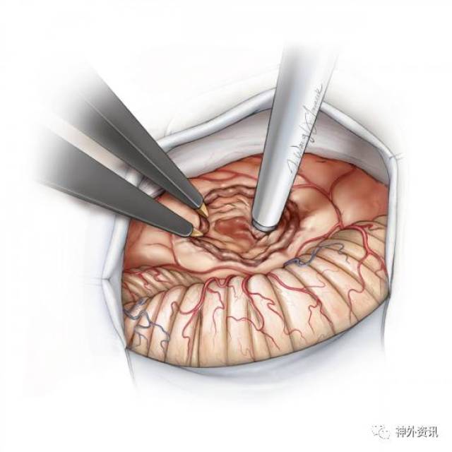 乙状窦后入路切除听神经瘤手术策略与技巧丨the neurosurgical atlas