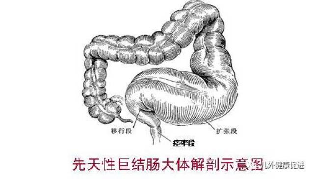 歪歪知识讲座——先天性巨结肠