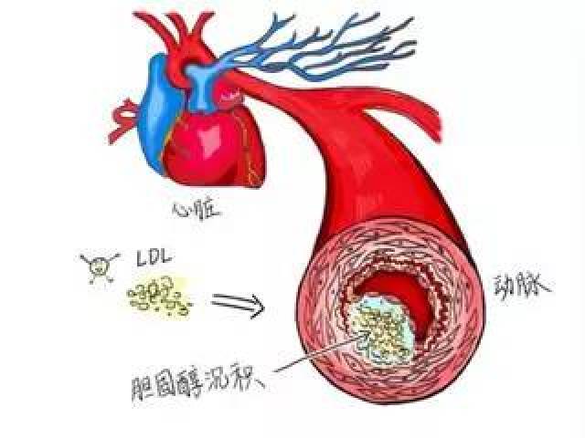 高胆固醇易致动脉粥样硬化,冠心病!应该注意什么?