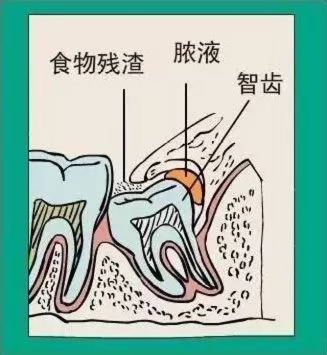 该不该拔?纠结多年的问题终于有了答案