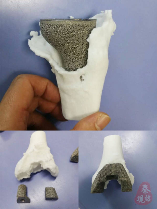 由于多次手术导致膝关节严重骨缺损,常规材料和人工假体均因无法处理