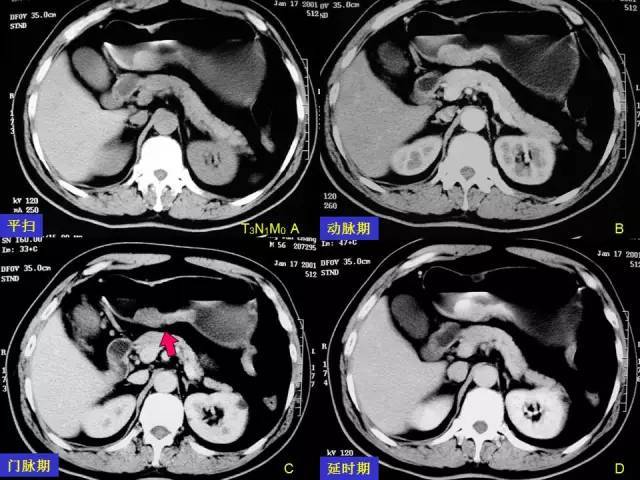 看了这篇 晋级胃癌 ct 诊断高手