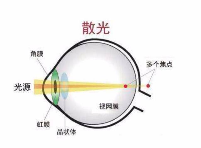 散光眼的5个日常保健方法