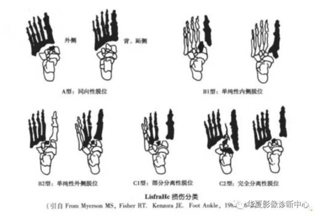 附:lisfranc损伤分型