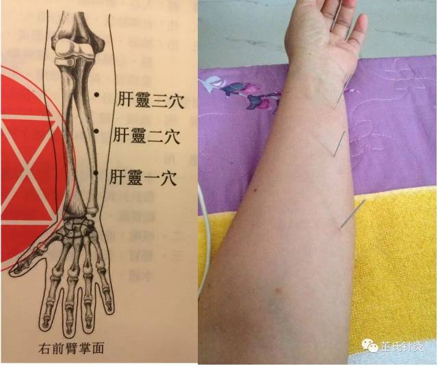 心灵穴,肝灵穴,上三黄,火串火陵火山,木斗木留 】临床上全部对侧取