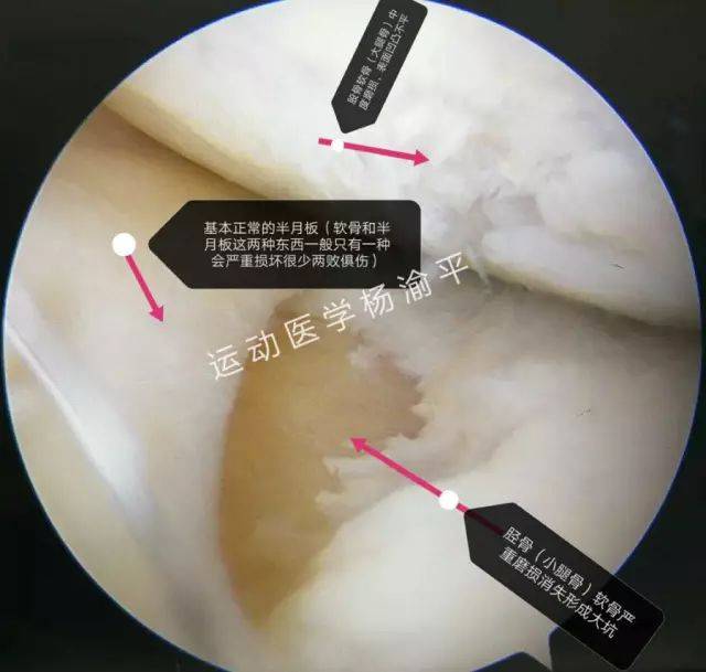 关节镜微创的手术清理,但是在手术中发现了股骨(大腿骨)软骨中度磨损