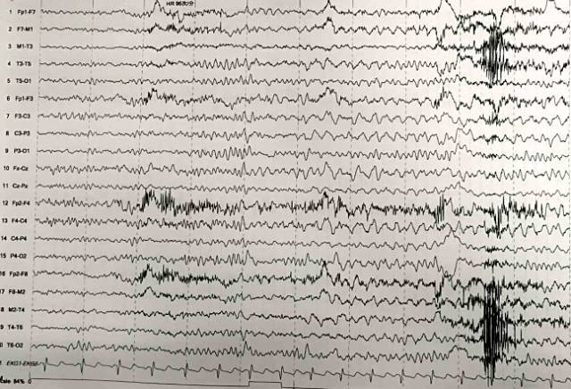 前头部阵发性θ活动,间歇期双侧半球可见到少量非同步性癫痫样放电