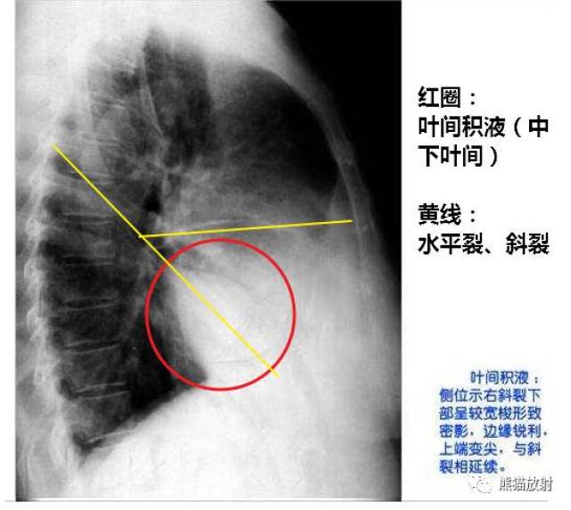 详解"胸腔积液"(形成机理及各类影像表现)