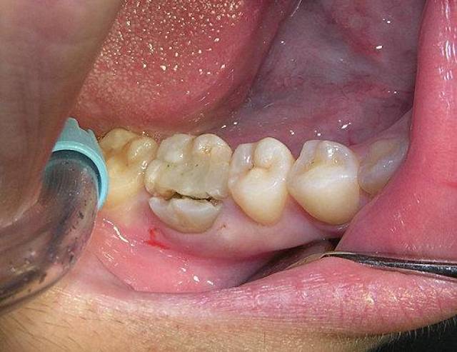 牙隐裂藏在嘴里 生活中随时都可能咬爆牙齿