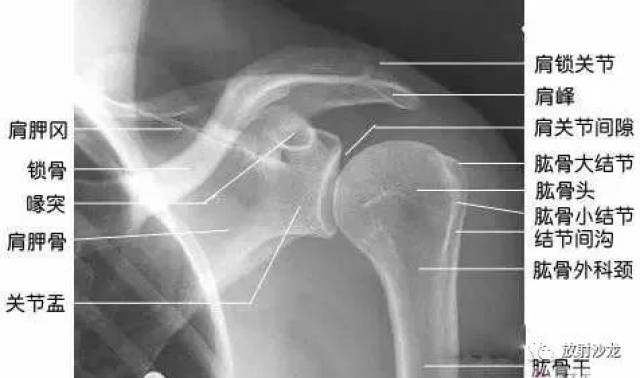 来源:新乡医学影像 1 肩关节盂环形骨骺约6岁开始化骨.
