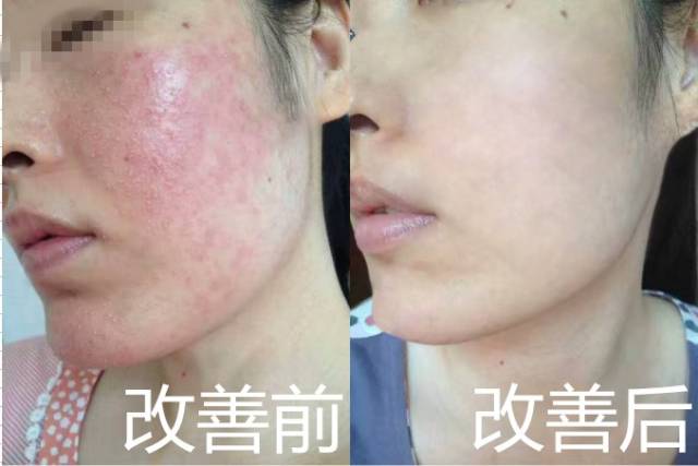 【蝶渡敏感肌修复案例连载006】激素脸冬天为什么会发红发热?