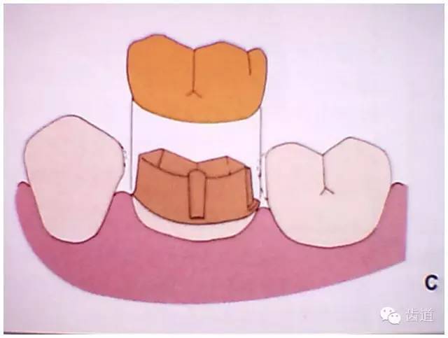 粘结力 l保留活髓及其整体性 l保留较多的牙体组织 l增加牙体抗力形的