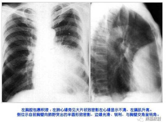 详解"胸腔积液"(形成机理及各类影像表现)