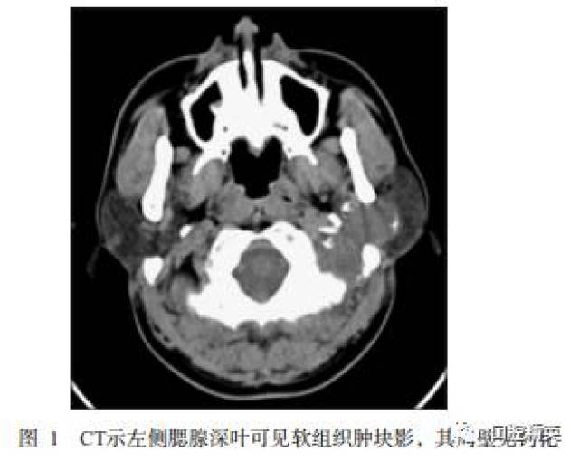 腮腺平扫ct示:左侧腮腺深叶见大小约2.6 cm×4.