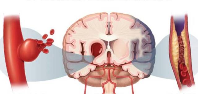 会不会脑中风,看身体有没有5个前兆,避免脑中风只需2招