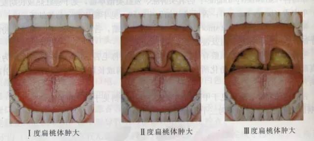 大家所熟知的咽部守卫者—扁桃体,准确来讲应该称为腭扁桃体,它们