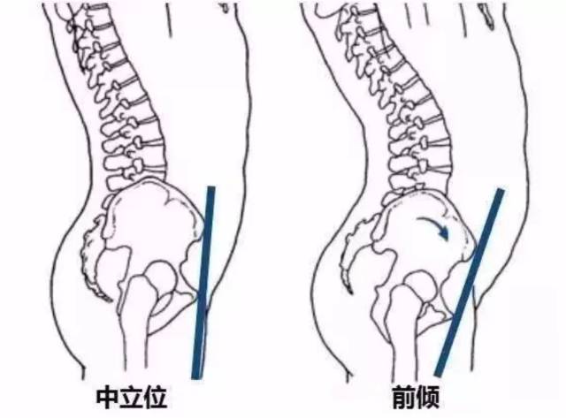 ok,咱们先来讲讲骨盆前倾.