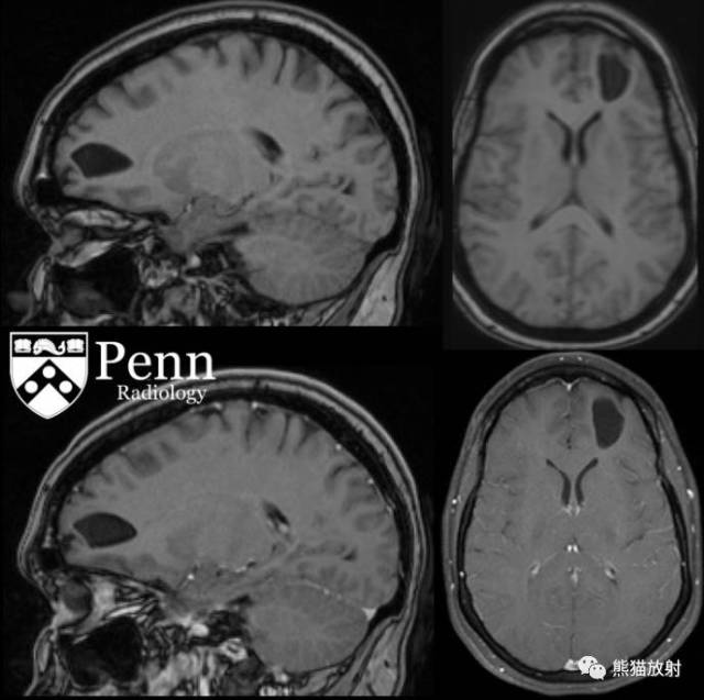双语病例丨脑内神经上皮囊肿mri表现