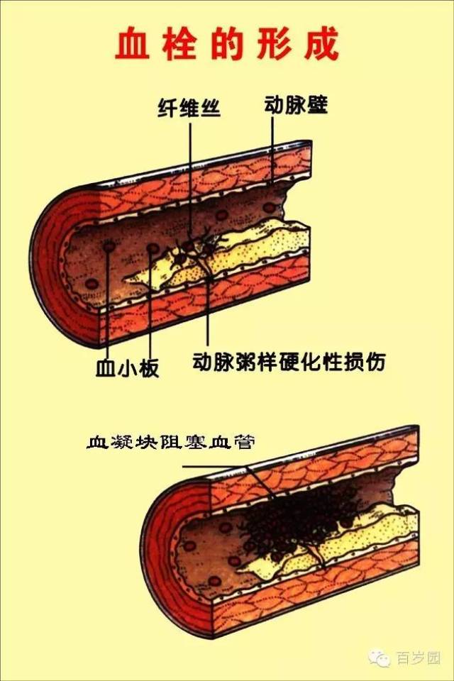 百岁园医学科普之二:颈动脉斑块的问题及健康调理干预