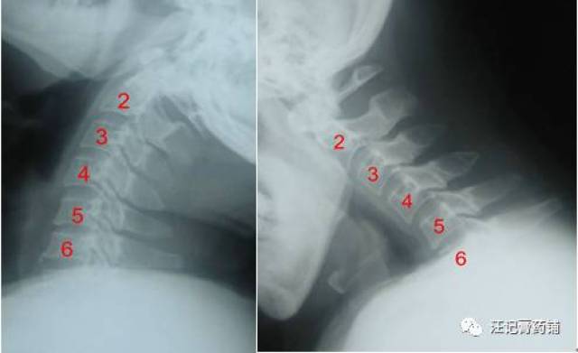 颈椎x光片能看懂吗?不求人你也能懂了!