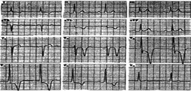 收藏丨一文读懂非冠心病心电图st-t改变