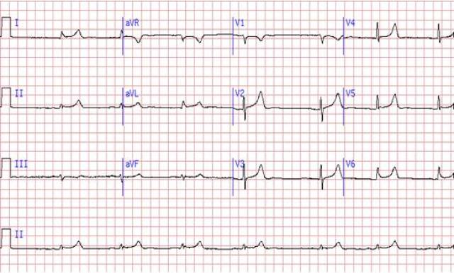 收藏丨一文读懂非冠心病心电图st-t改变