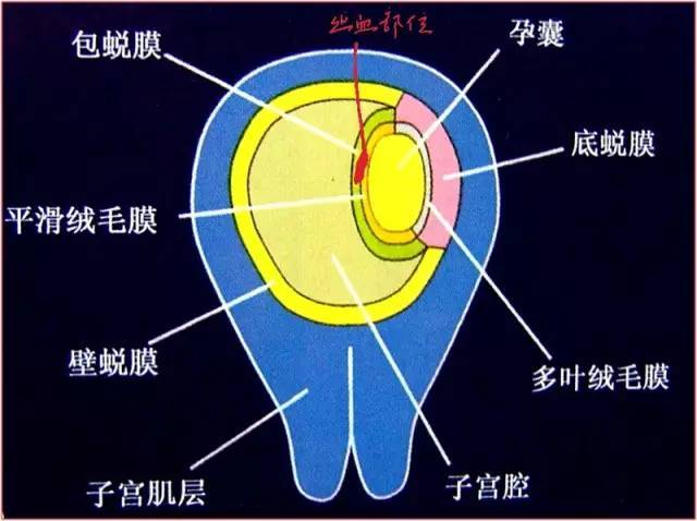 绒毛膜下血肿