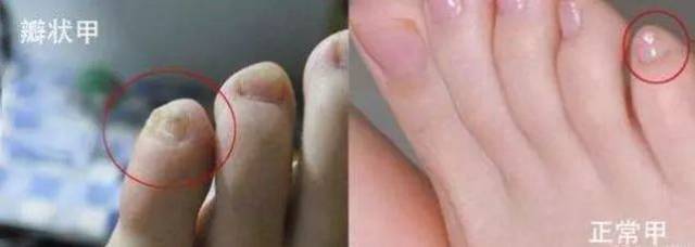 你的小脚趾指甲是两瓣吗?快来看看你的祖先是哪里人