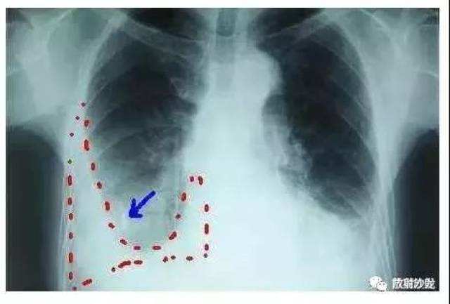 详解"胸腔积液"(形成机理及各类影像表现)