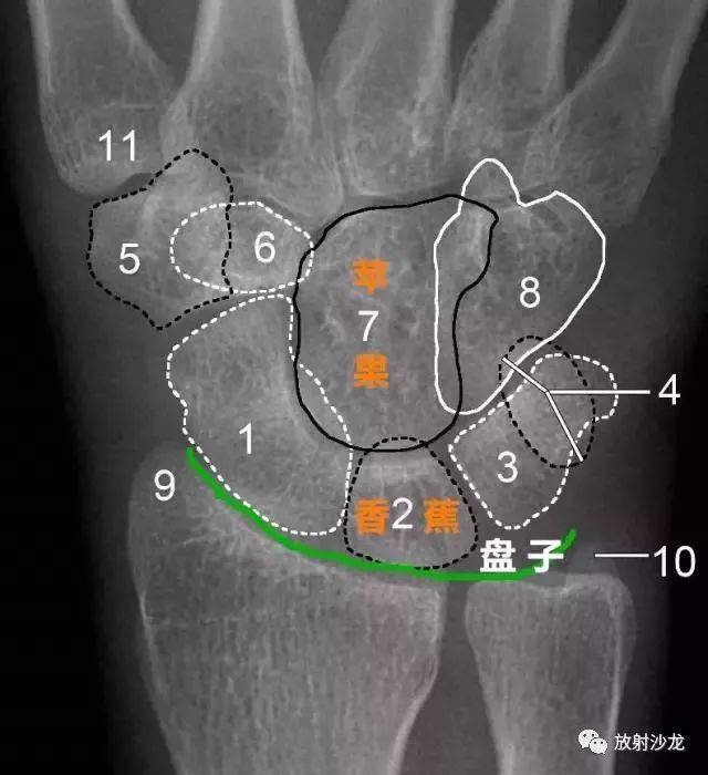 豆状骨 5.大多角骨 6.小多角骨 7.头状骨 8.钩骨 9.桡骨茎突 10.