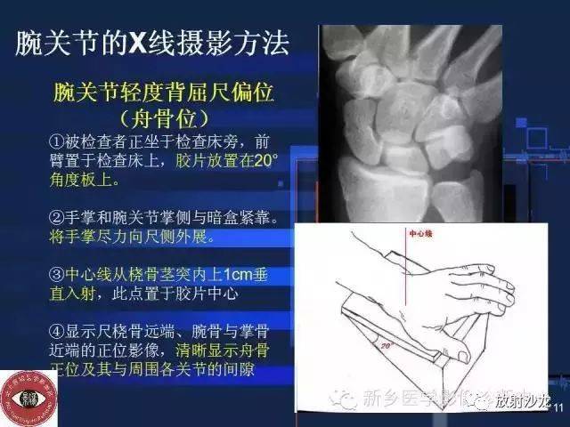 详细的腕关节x线解剖 摄影技巧 阅片技巧 测量