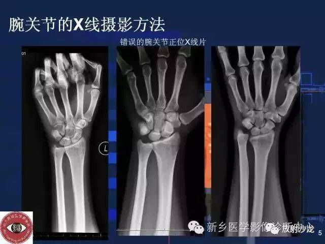 1,腕关节x线下的正常形态