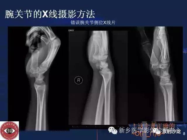 1,腕关节x线下的正常形态