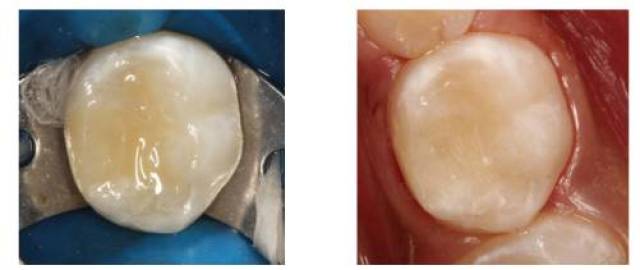 树脂改良型玻璃离子充填窝洞    :调颌抛光