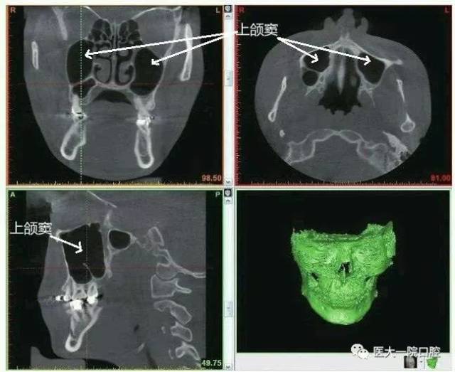 ct图像中上颌后牙根方的黑色腔隙即为上颌窦