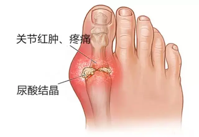 三棱针刺络放血与原发性痛风