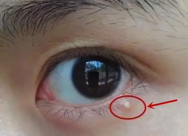 一般急性肾炎导致的眼皮浮肿多数是在早晨明显;而心脏功能不好的人